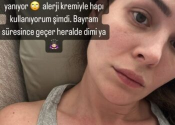 Güneş alerjisinden dolayı vücudu kabaran Yıldız Çağrı Atiksoy, son haliyle sevenlerini korkuttu