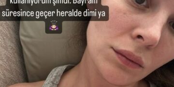 Güneş alerjisinden dolayı vücudu kabaran Yıldız Çağrı Atiksoy, son haliyle sevenlerini korkuttu