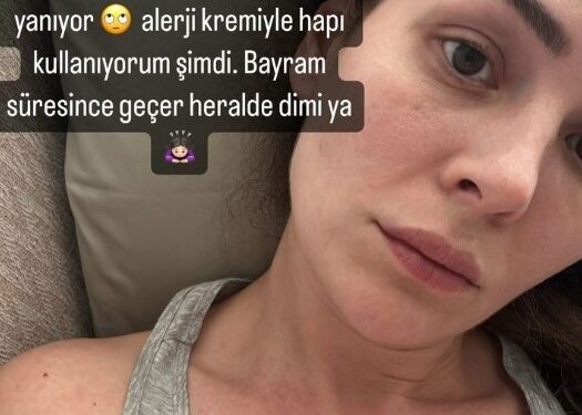 Güneş alerjisinden dolayı vücudu kabaran Yıldız Çağrı Atiksoy, son haliyle sevenlerini korkuttu