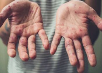 Kızamık vakaları her gün artıyor: Uyarı var ama eylem yok!