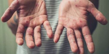 Kızamık vakaları her gün artıyor: Uyarı var ama eylem yok!