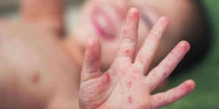 ‘Kızamık vakalarındaki artışın en önemli sebebi aşı karşıtlığı’