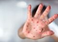 Uzmanından ‘kızamık virüsü’ hakkında uyarılar