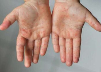 Uzmanı ‘kızamık virüsü’ hakkında uyarılarda bulundu