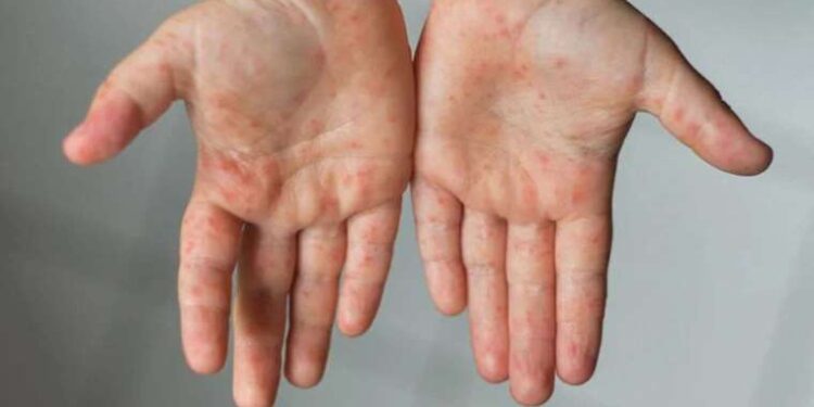 Uzmanı ‘kızamık virüsü’ hakkında uyarılarda bulundu