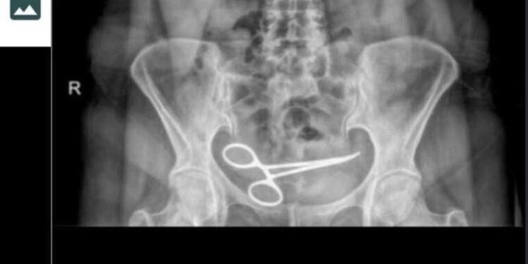 Karnında makas unuttular: 8 ay sonra fark edildi!