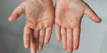 'Kızamıktan korunmada en etkili yöntem aşı yaptırmak'