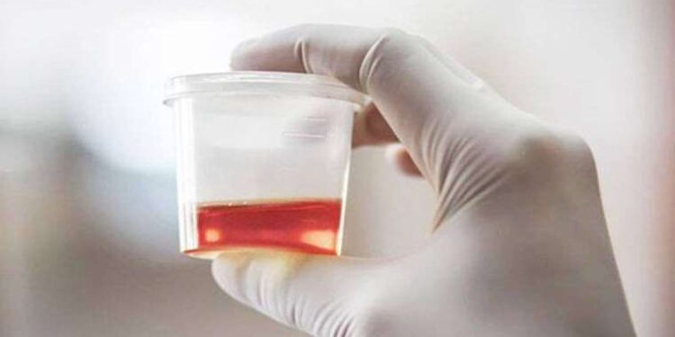 Pek çok hastalığın habercisi: İdrarda görülen kana dikkat!