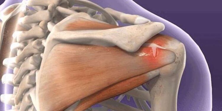 Tedavi edilmeyen omuz yırtıkları dikkate alınmalı