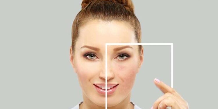 Bu belirtilere sahipseniz Gül hastalığına yakalanmış olabilirsiniz!