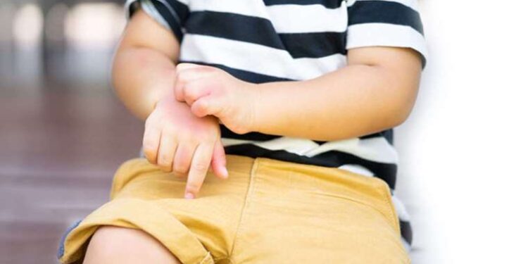 Uzmanlar uyardı: Egzama genellikle çocukluk döneminde başlıyor