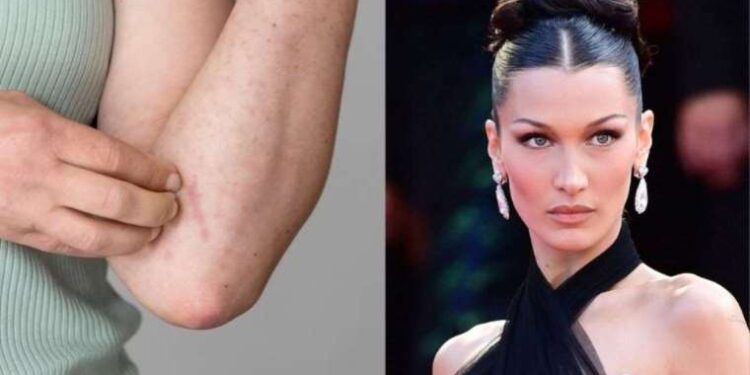 Lyme hastalığı nedir? Bella Hadid’in hastalığı Lyme’nin belirtileri nedir? Lyme hastalığının tedavisi var mı?