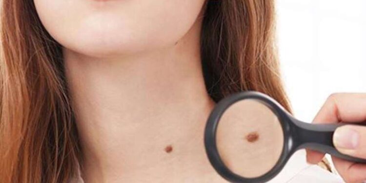 Aksesuarlarınız et beni oluşumunu tetikleyebilir