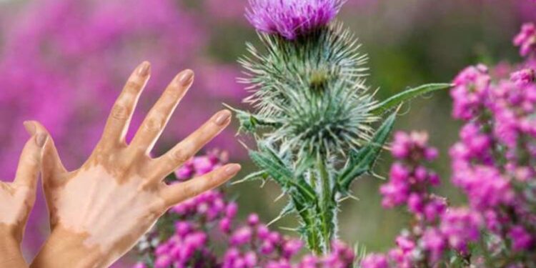 Bu mucizevi bitki vitiligo hastalığına birebir!