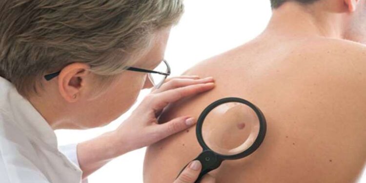 Benlerinizdeki renk değişimi kanser habercisi olabilir