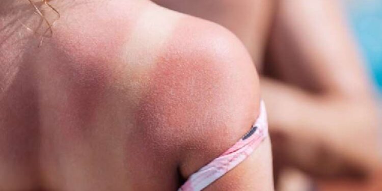 Deniz kum güneşin tehlikeli yanı: Güneş yanığı