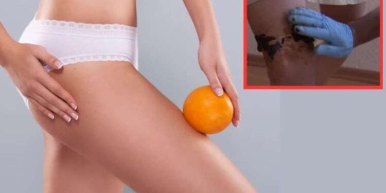 Kahve telvesini sakın çöpe atmayın! Evde yapacağınız bu karışım 6 haftada sizi selülitlerden kurtaracak…