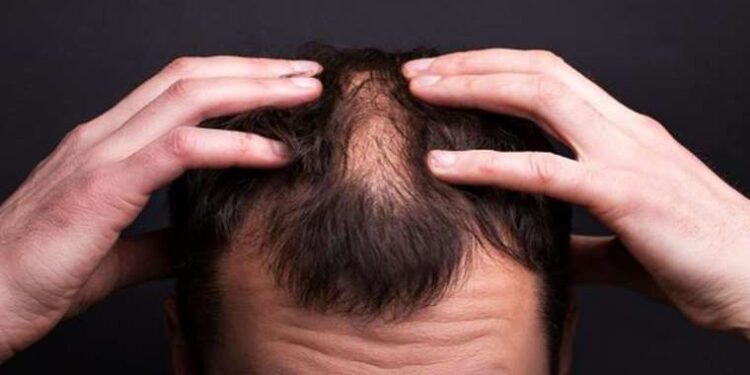 Saçkıran nedir? Belirtileri ve tedavi yöntemleri