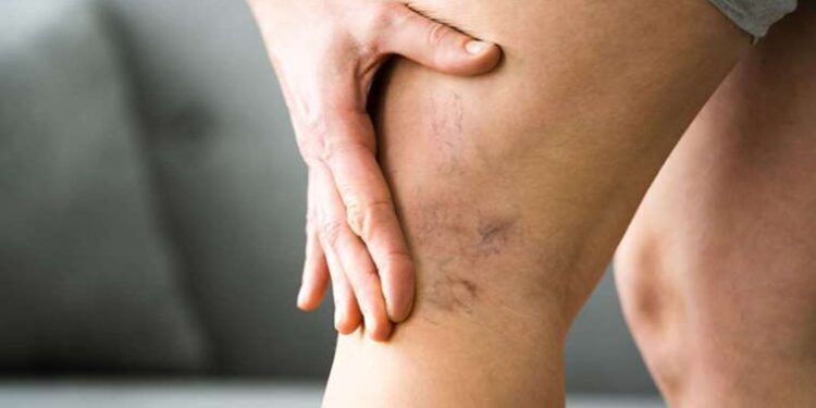 Varise karşı evde uygulayabileceğiniz yöntem: 1 bardağı yeterli oluyor… Hepsini yok edin