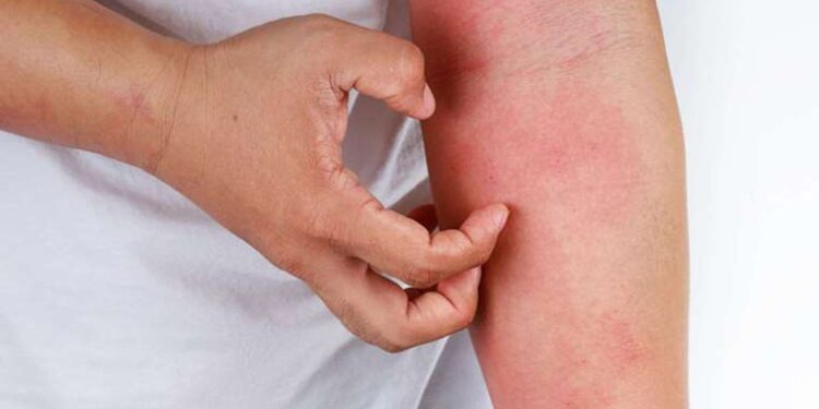 Pandemi vatandaşı “uyuz” etti: Koronavirüs sonrası uyuz vakaları arttı