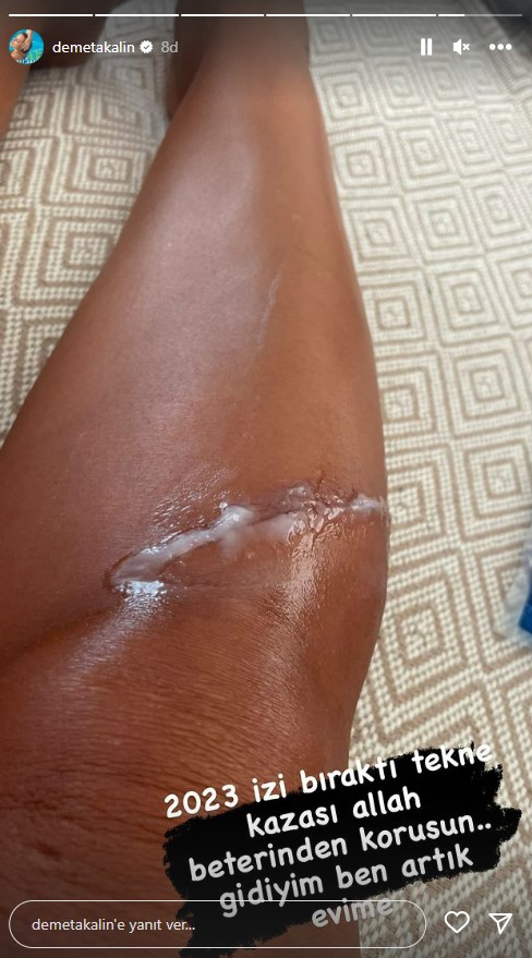 tekne-kazasinda-olumden-donen-demet-akalin-16265568_1715_m-1 Tekne kazasında ölümden dönen Demet Akalın, yaralanan bacağını gösterdi