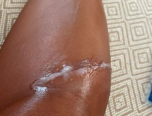 Tekne kazasında ölümden dönen Demet Akalın, yaralanan bacağını gösterdi