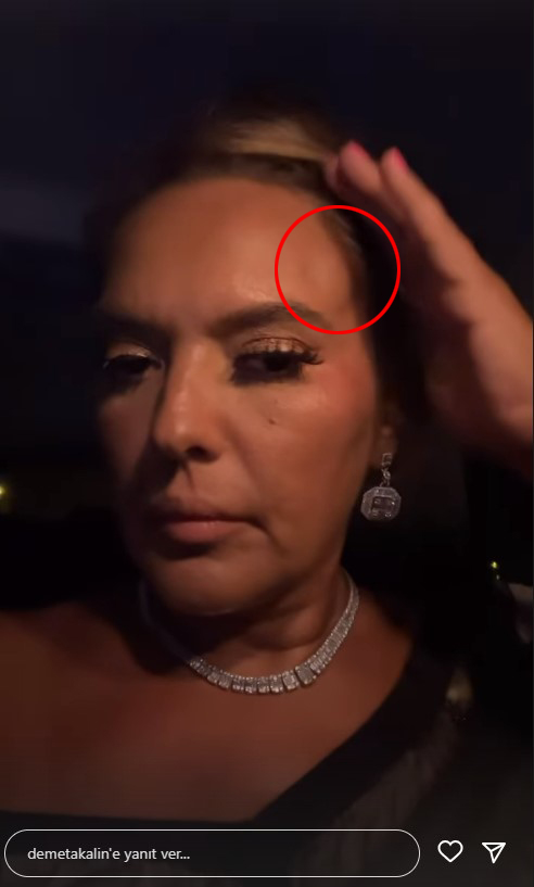 tekne-kazasinda-olumden-donen-demet-akalin-16265568_5097_m Tekne kazasında ölümden dönen Demet Akalın, yaralanan bacağını gösterdi