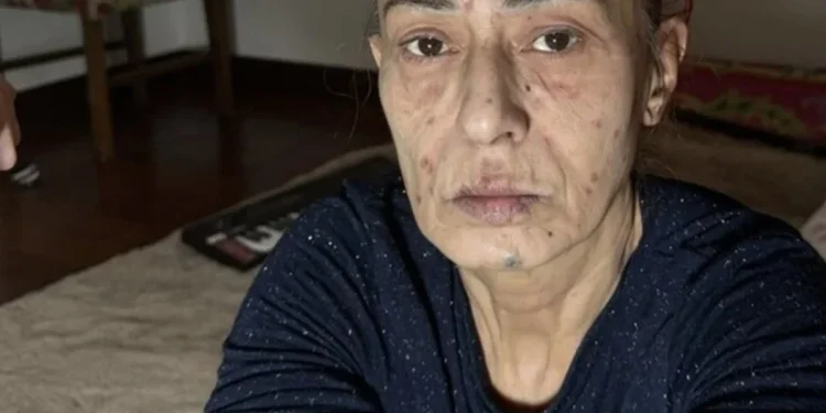 Yıldız Tilbe'den Yüzü Yanma Olayına İlişkin Yeni Açıklama