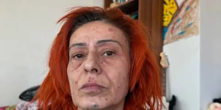 Yıldız Tilbe, saç boyası nedeniyle oluşan yanıkları anlattı