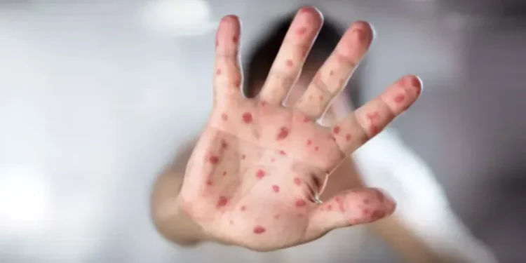 "Kızamık Alarmı: Tekrar Yayılıyor"