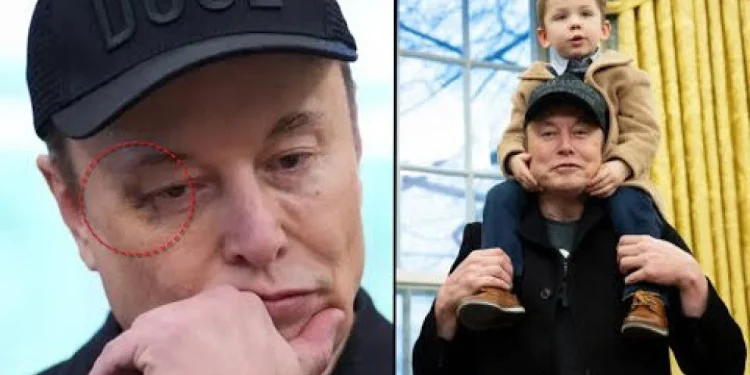 Elon Musk, Trump’la poz verdi; gözündeki morluk şaşırttı