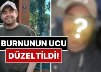 11 Kez Ameliyat Geçiren Murat Dalkılıç’ın Burnunun Ucu Estetik Müdahalelerle Düzeltildi!