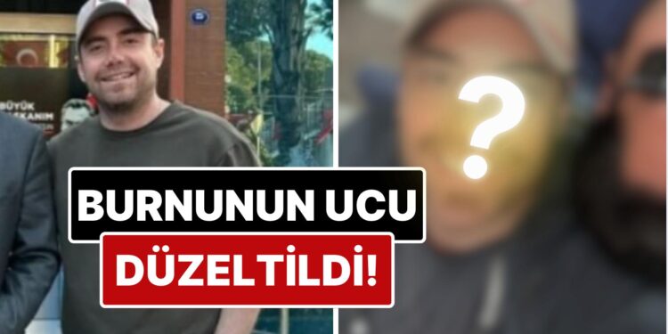 11 Kez Ameliyat Geçiren Murat Dalkılıç’ın Burnunun Ucu Estetik Müdahalelerle Düzeltildi!