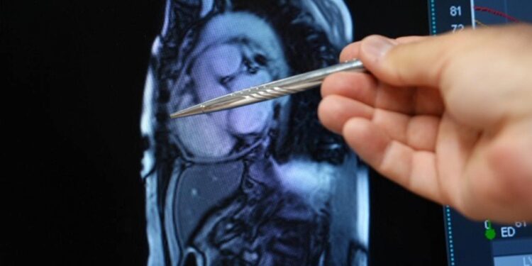 Yıllarca yanlış tedavi gördü, kalbi taşlaştı! Gerçek sorun ortaya çıktı, sağlığına kavuştu