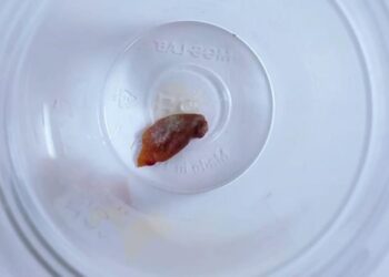 1,5 yıllık öksürüğün sebebi, kabak çekirdeği çıktı