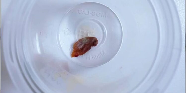 1,5 yıllık öksürüğün sebebi, kabak çekirdeği çıktı