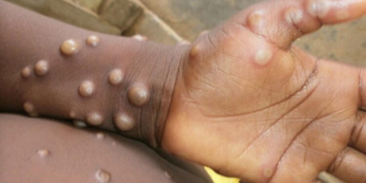 Gana’da M. Çiçeği alarmı… 583’e çıktı!