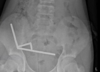 200 mıknatıs yuttu, bağırsaklarının bir kısmını kaybetti