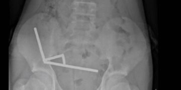 200 mıknatıs yuttu, bağırsaklarının bir kısmını kaybetti