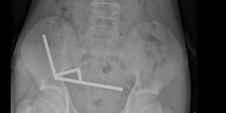 200 mıknatıs yuttu, bağırsaklarının bir kısmını kaybetti