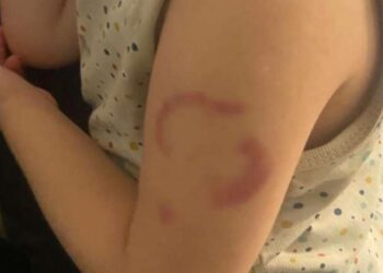 Edirne’de ‘öğretmen çocuğun kolunu ısırdı’ iddiası