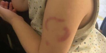 Edirne’de ‘öğretmen çocuğun kolunu ısırdı’ iddiası