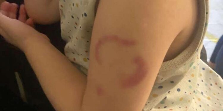 Edirne’de ‘öğretmen çocuğun kolunu ısırdı’ iddiası