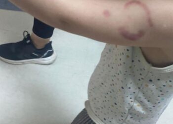 Kreşte kan donduran olay: Öğretmen çocuğun kolunu ısırdı