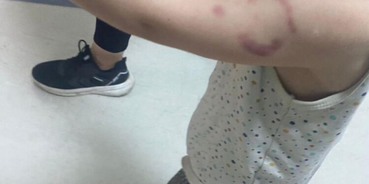 Kreşte kan donduran olay: Öğretmen çocuğun kolunu ısırdı