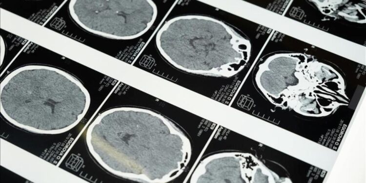 Uzmanlardan masajla gelen inme uyarısı