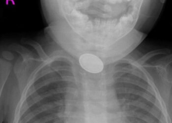 Kayseri’de 15 aylık bebeğin yemek borusuna pil ve lego parçası kaçtı