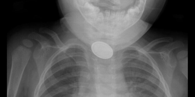 Kayseri’de 15 aylık bebeğin yemek borusuna pil ve lego parçası kaçtı