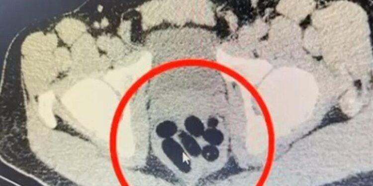 Kayseri’de uyuşturucu operasyonu: Midesinden çıkan şoke etti