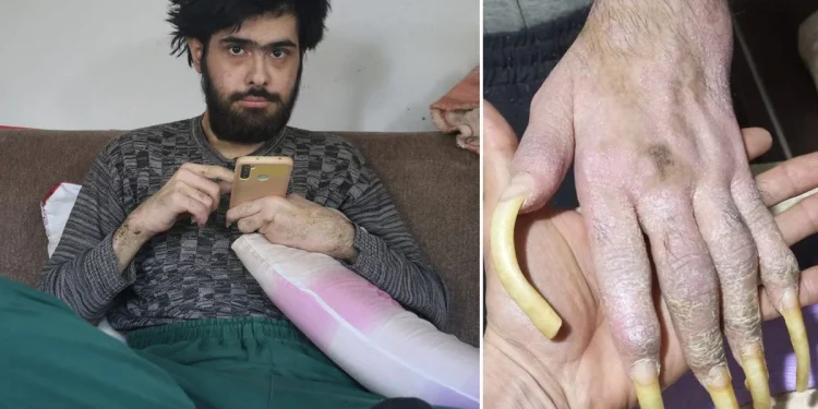 Türkiye’nin konuştuğu Barış’ın son hali! 25 yaşını kutladı, türkü bile söyledi